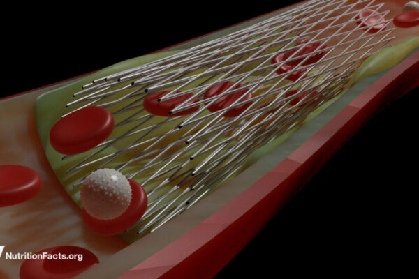 Do Heart Stents Benefit Angina Chest Pain? … from WebMD Michael Greger M.D. FACLM