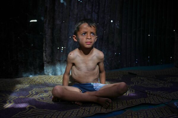 AP PHOTOS: Many in Gaza face malnutrition and hunger as blockade enters its third month … from the Independent The Associated Press