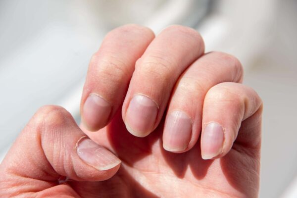The subtle nail signs that may indicate underlying health issues … from the Independent Lara Owen