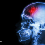 Fasting and Plant-Based Diets for Migraines and Traumatic Brain Injuries  … from WebMD Michael Greger M.D. FACLM